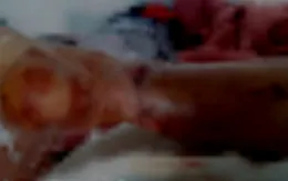 Người phụ nữ bị rách cơ, đứt mạch máu, dây thần kinh do kính cắt vào chân