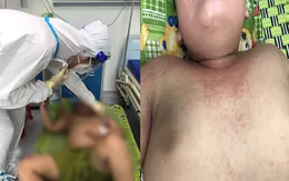 Chuẩn bị ra viện sau mắc COVID-19 nặng, bé trai xuất hiện hội chứng viêm đa hệ thống