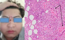Cảnh giác với loại nấm Conidiobolus gây biến dạng mặt