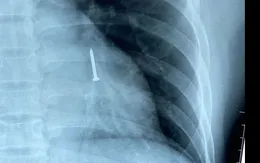 Nội soi gắp đinh sắt dài 3 cm trong phế quản bệnh nhân