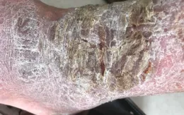 Trời rét, người bị viêm da cơ địa cần chăm sóc thế nào?