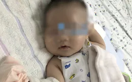 Cứu sống bé 1,5 tháng tuổi bị viêm mô tế bào hóa mủ nặng vùng má