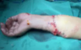 Nối thành công cẳng tay bị đứt lìa cho bệnh nhân