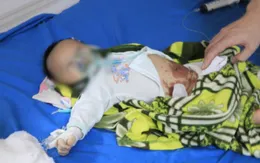Đắp tỏi điều trị COVID-19, bé 2 tháng tuổi nhập viện cấp cứu trong tình trạng nguy kịch