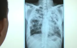 Bé gái 12 tuổi nguy kịch vì mắc vi trùng lao