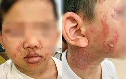Cảnh báo viêm da tiếp xúc do kiến ba khoang