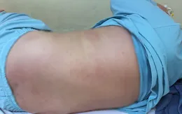 Hậu COVID-19: Bé 10 tuổi sốt cao, ho khan, nổi ban đỏ khắp cơ thể
