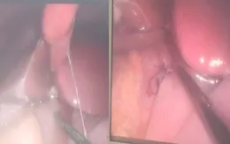 Cảnh báo tình trạng thủng dạ dày ở trẻ em từ thói quen sống, sinh hoạt thiếu khoa học
