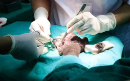 Bàn tay nhiễm trùng nặng sau 3 ngày bị máy bóc gỗ lóc da