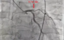 Người đàn ông ngừng tim ngoại viện do nhồi máu cơ tim cấp