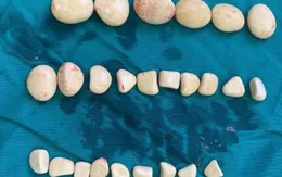 Phẫu thuật lấy hàng chục viên sỏi trong bàng quang bệnh nhân
