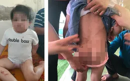 Bé 4 tuổi nhập viện với nhiều vết thương, nghi bị bạo hành
