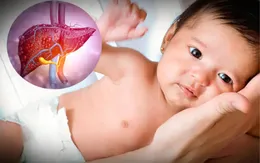 Bộ Y tế: Tăng cường giám sát trường hợp viêm gan cấp tính không rõ nguyên nhân