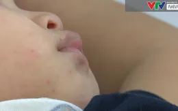 Cẩn trọng: Bệnh tay chân miệng đang vào mùa