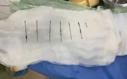 Hi hữu: Lấy 7 cây kim gỉ sét trong lồng ngực bệnh nhân