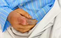 Bị rắn độc cắn khi đi lấy củi, kéo đường lưới điện