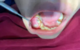 Bé 12 tuổi phải nhập viện vì biến chứng nang xương hàm