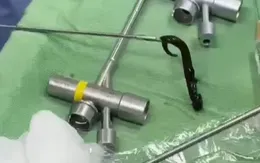 Gắp con vắt rừng ký sinh trong đường thở bé 6 tuổi