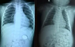 Cẩn trọng khi trẻ nuốt phải dị vật