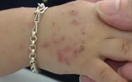 Bệnh tay chân miệng gia tăng, cảnh giác biến chứng nặng