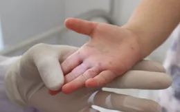 TP. Hồ Chí Minh: 95 ổ dịch sốt xuất huyết, 4 ổ dịch tay chân miệng phát sinh trong tuần qua