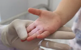 Những sai lầm khiến trẻ mắc tay chân miệng trở nặng