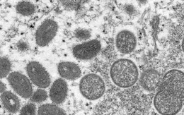 Tình trạng y tế khẩn cấp toàn cầu vì Đậu mùa khỉ: Việt Nam kích hoạt những biện pháp ứng phó kịp thời