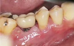 Nguy hiểm tiềm ẩn khi trồng implant giá rẻ