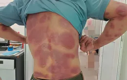 Dị ứng nặng do tự mua thuốc điều trị