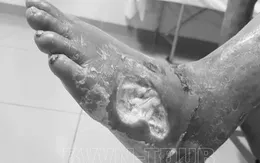 Người bệnh đái tháo đường bị nhiễm trùng, hoại tử bàn chân do tự ý dùng thuốc