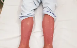 6 biến chứng nguy hiểm của sốt xuất huyết Dengue