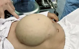 Phẫu thuật thoát vị thành bụng lớn kèm dị tật ruột xoay dở dang cho bé trai người Lào