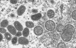 Cảnh báo virus đậu mùa khỉ có thể đã âm thầm lây lan