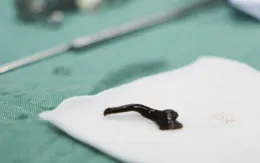 Thường xuyên chảy máu cam, bác sĩ nội soi phát hiện vắt ký sinh
