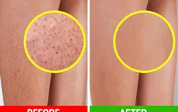 6 cách tự cải thiện làn da viêm nang lông tại nhà