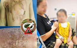 Tự ý đắp lá cây chữa bệnh, nhiều trẻ bị bỏng nặng, nhiễm trùng