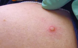 Bệnh đậu mùa khỉ: Triệu chứng và cơ chế lây thế nào?