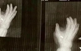 Cháu bé 4 tuổi bị trúng đạn trong vụ nổ súng tại quán karaoke