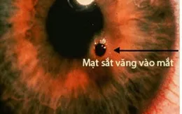 Gắp mảnh vụn sắt găm vào giác mạc bệnh nhân
