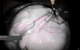 Phẫu thuật khối u nặng 10kg cho bệnh nhân nữ 62 tuổi