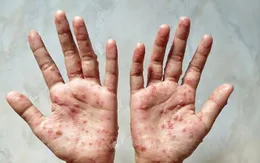 6 khuyến cáo phòng chống bệnh đậu mùa khỉ