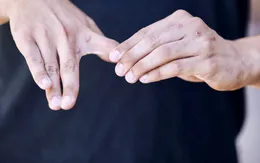 Tổ chức Y tế thế giới cập nhật thông tin về bệnh đậu mùa khỉ