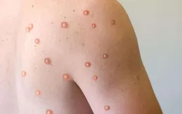 Cần làm gì khi mắc bệnh đậu mùa khỉ hoặc tiếp xúc gần người bệnh?