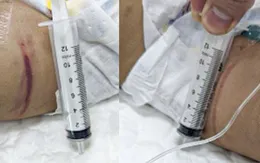Cập nhật tình trạng sức khỏe của bé gái 18 tháng tuổi nghi bị bạo hành tại Hà Nội