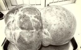 Phẫu thuật khối u nang buồng trứng nặng hơn 7kg cho bệnh nhân