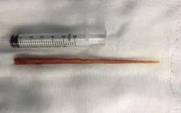 Lấy dăm gỗ dài 15cm găm vào thành ngực bệnh nhân