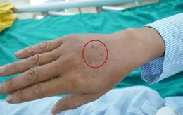 Cấp cứu bệnh nhân sốc phản vệ nguy kịch do ong vò vẽ đốt