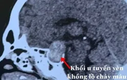 Nam bệnh nhân bị mất thị lực đột ngột do khối u tuyến yên chảy máu