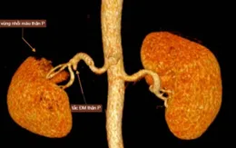 Đi khám vì đau bụng, người đàn ông phát hiện mắc bệnh lý thận hiếm gặp
