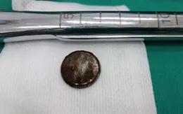 Pin cúc áo - dị vật nguy hiểm đối với trẻ